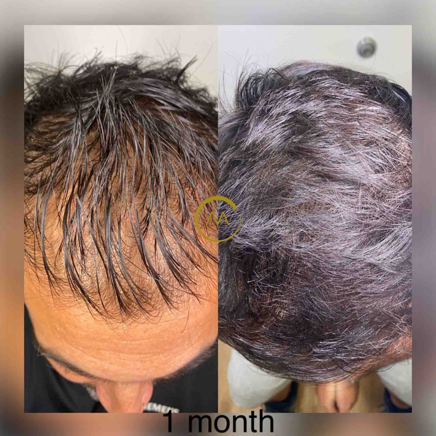 gallery-hair-restoration-2b-1