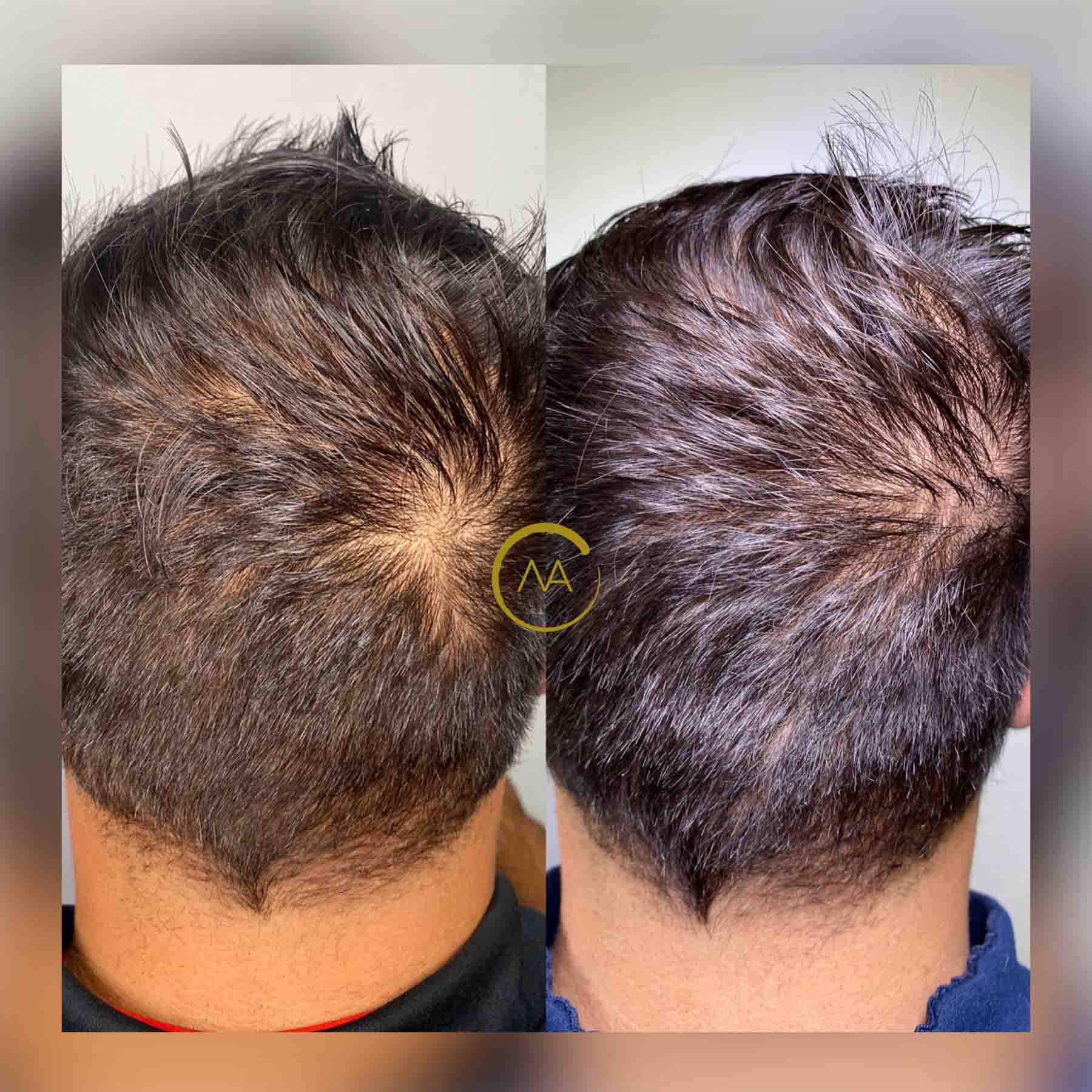 gallery-hair-restoration-2b-2