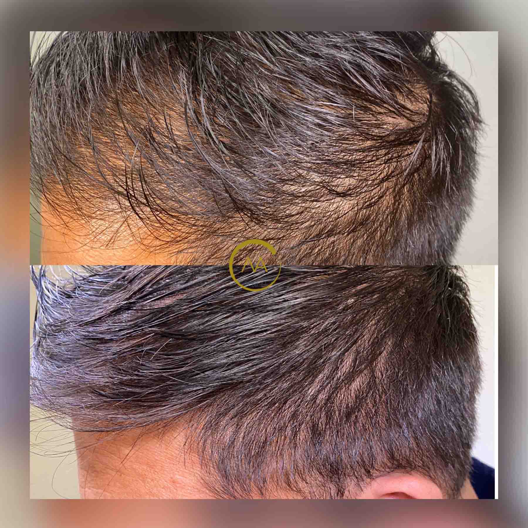 gallery-hair-restoration-2b-3