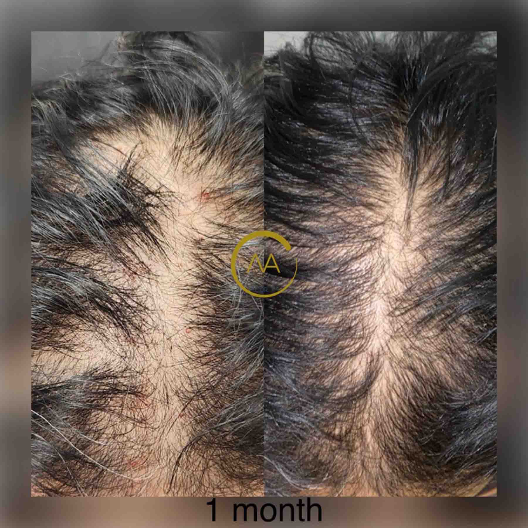 gallery-hair-restoration-3b-1