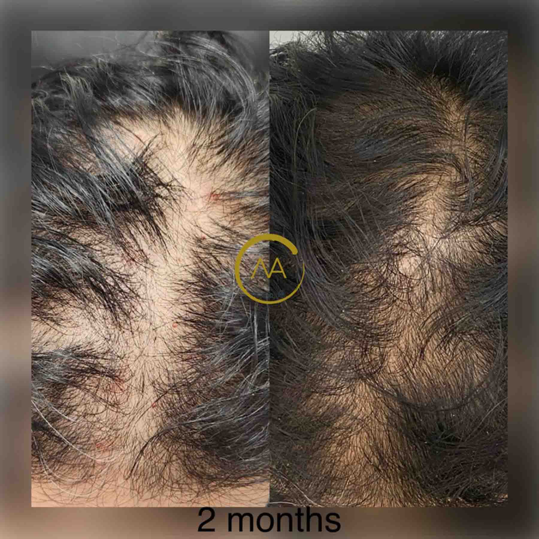 gallery-hair-restoration-3b-2