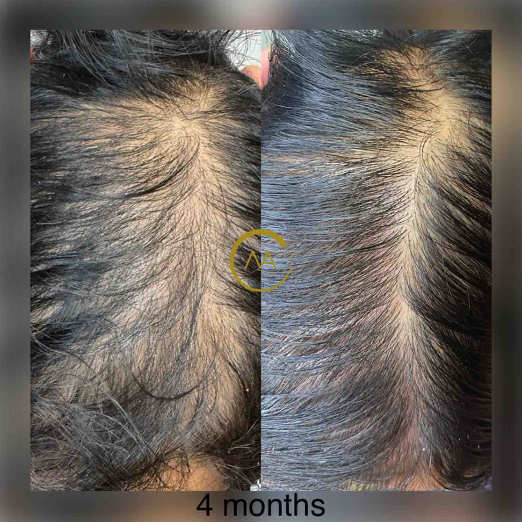 gallery-hair-restoration-4b-3