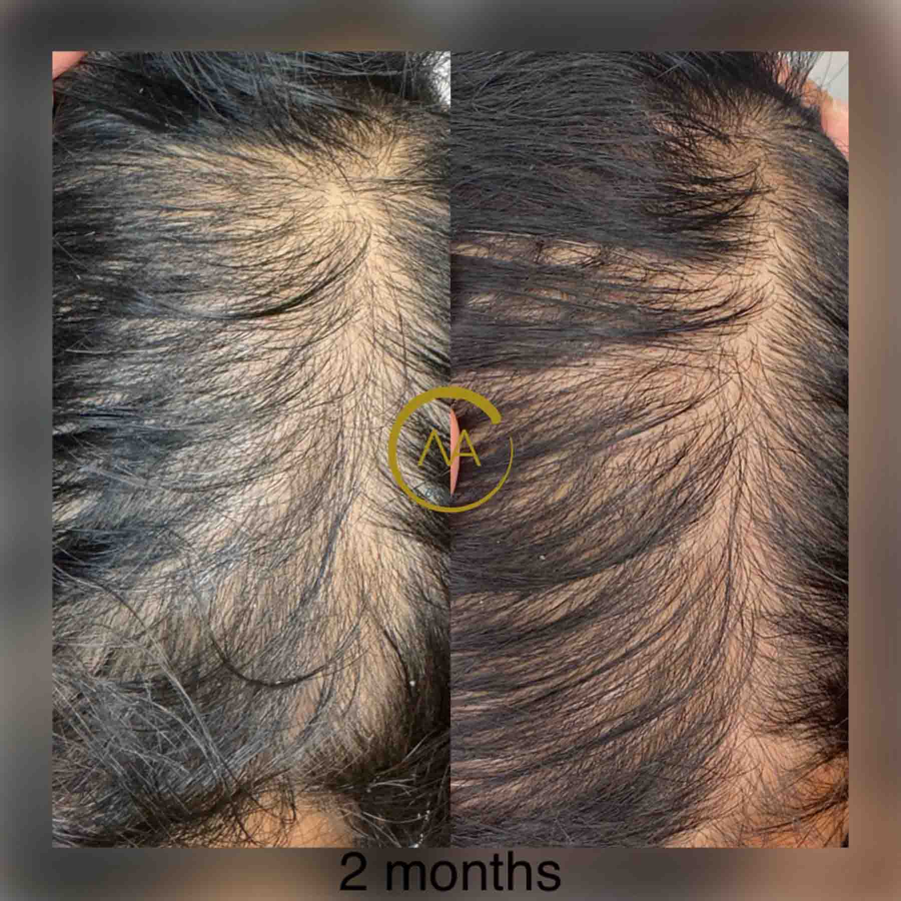 gallery-hair-restoration-4b-4