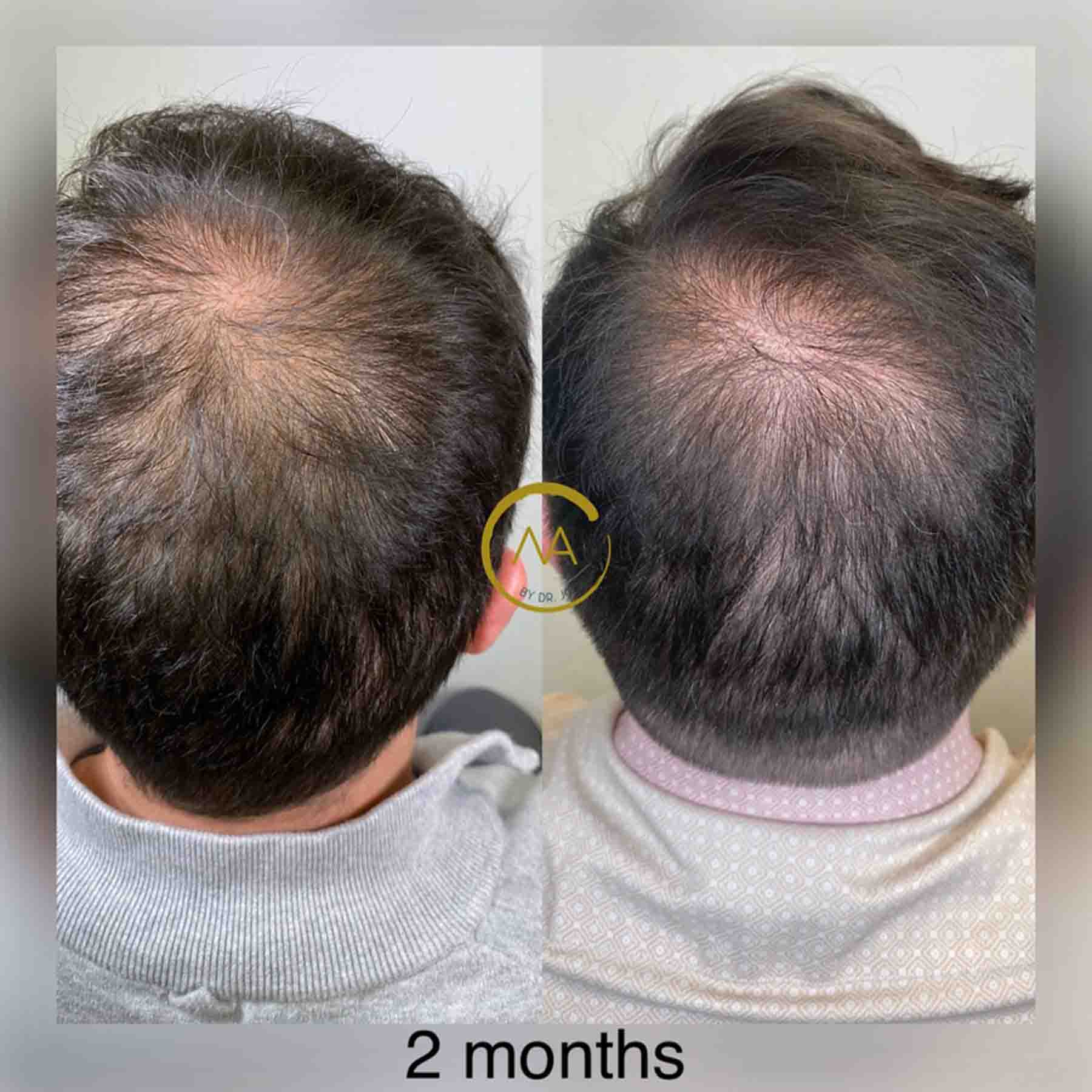 gallery-hair-restoration-5b-2