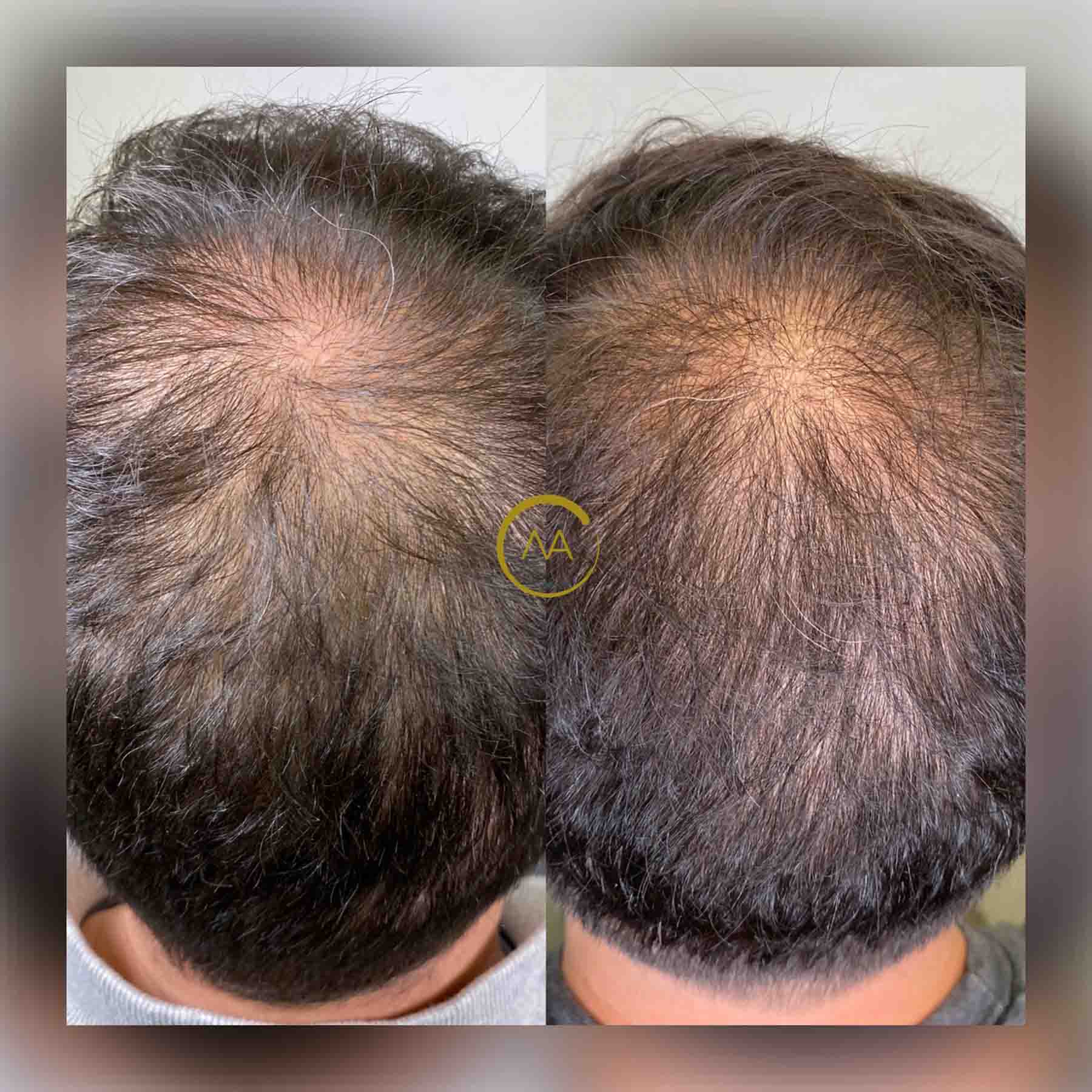 gallery-hair-restoration-5b-3