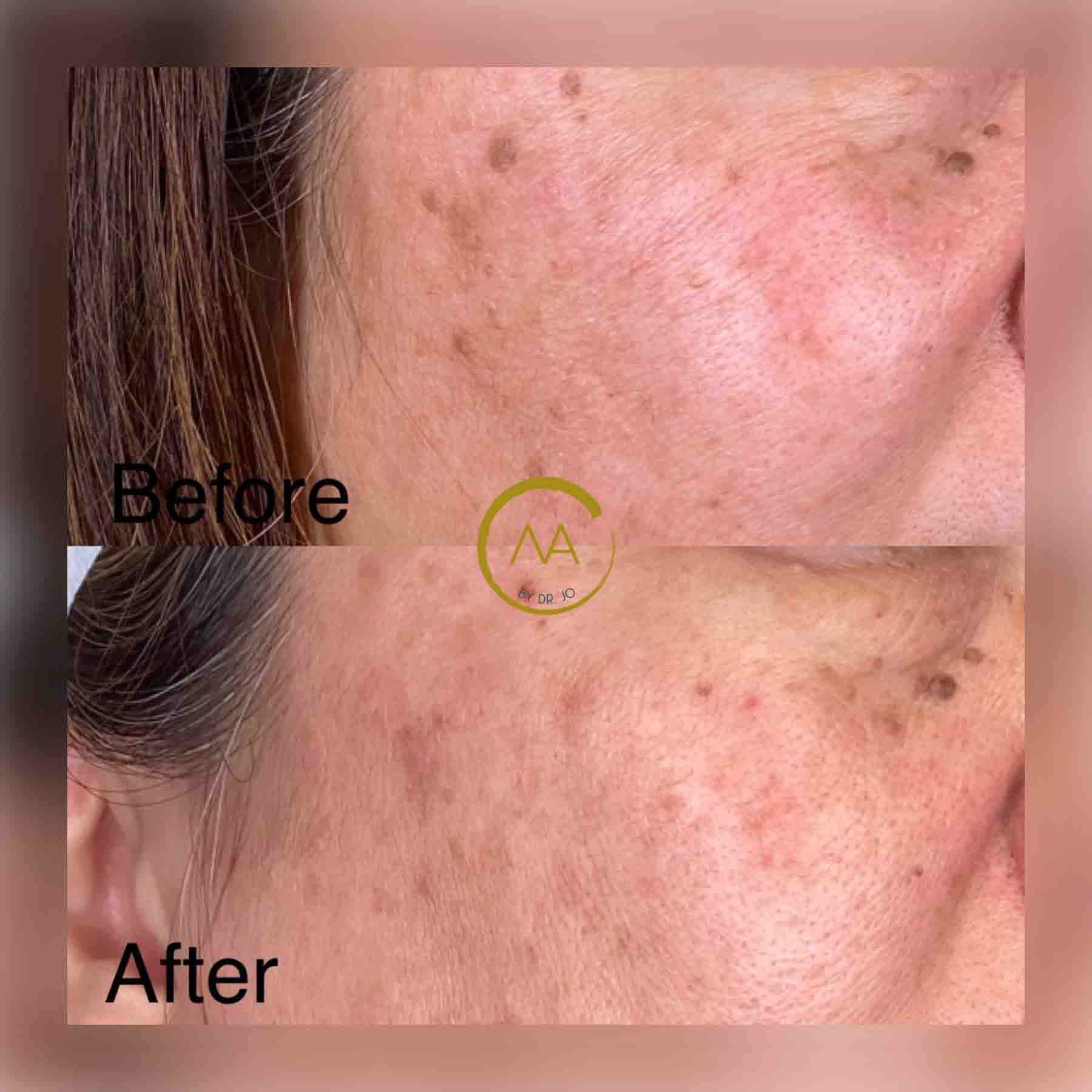 gallery-microneedling-2b-1