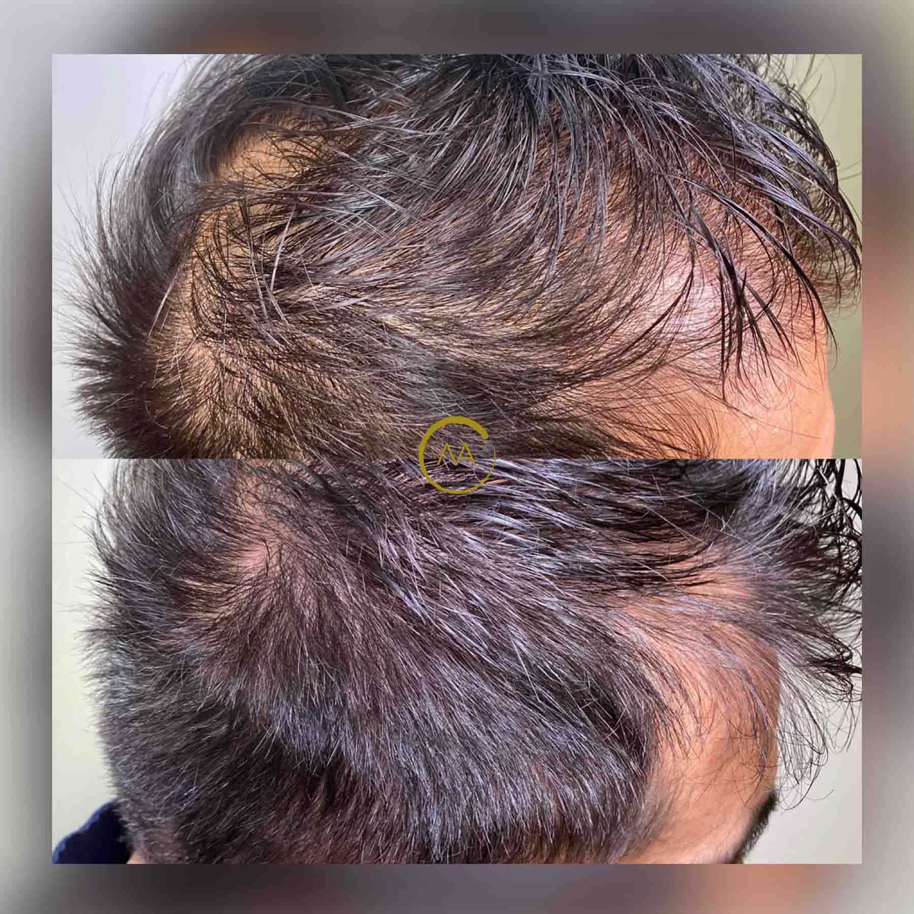 gallery-hair-restoration-1b