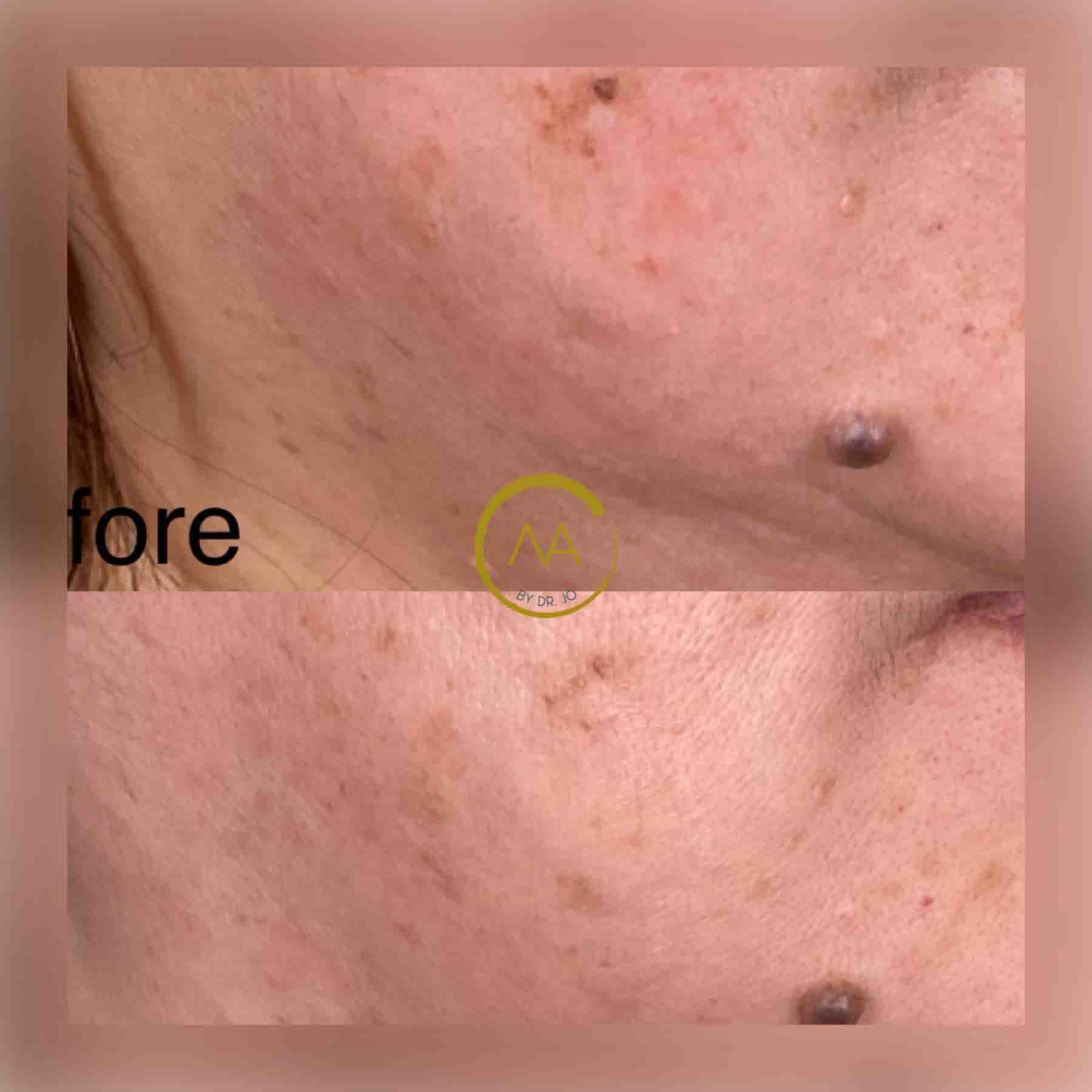 gallery-microneedling-2b-3 A woman's cheek before and after microneedling in Los Gatos, CA.