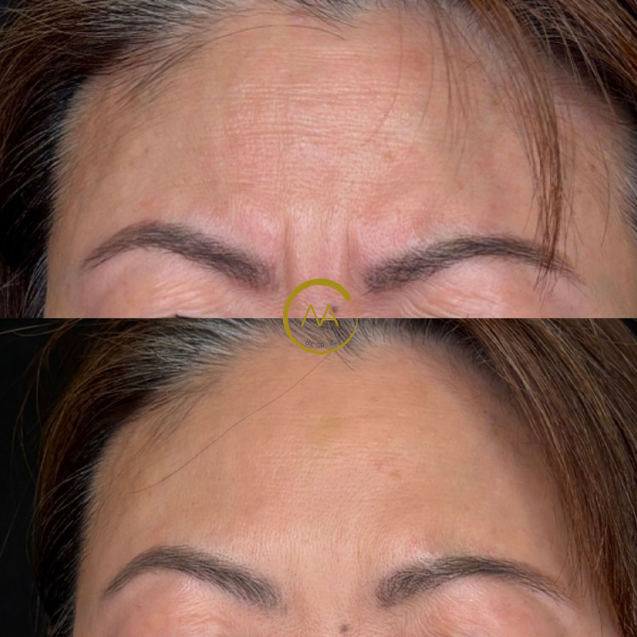sk-botox-1