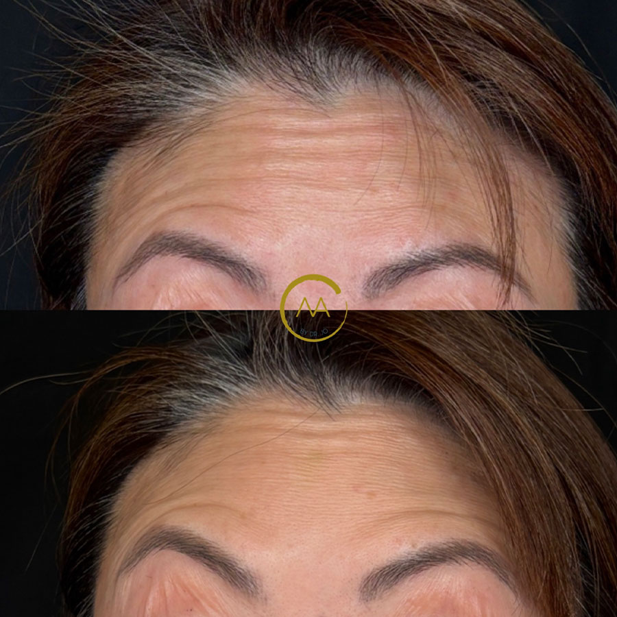 sk-botox-2
